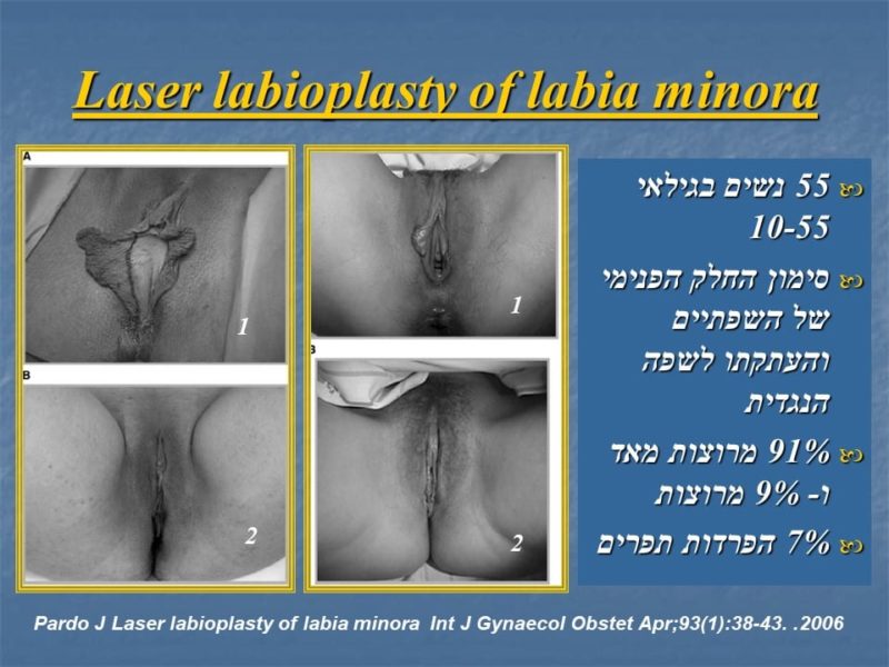 מצגת כירורגיה פלסטית של הנרתיק והפות (36)